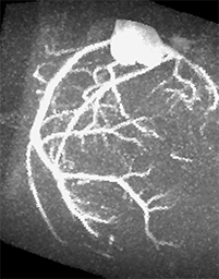 coronaryAngiogram